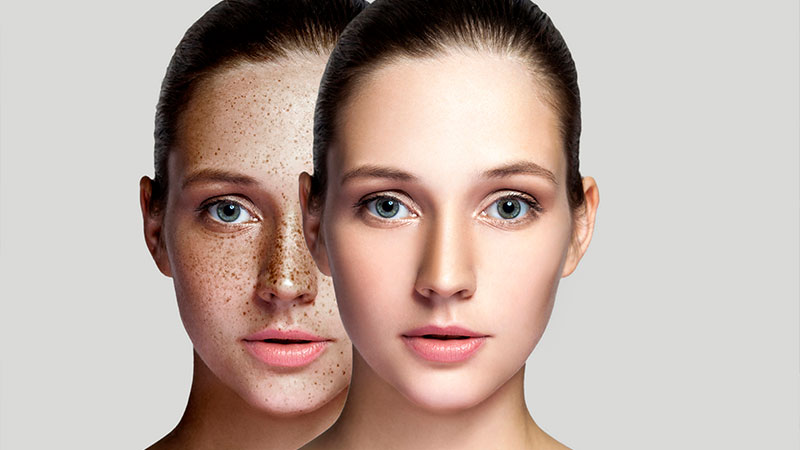 Skin lightening & De-pigmentation